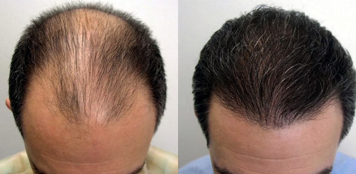 Пересадка волос выпадают волосы. До и после пересадки волос.