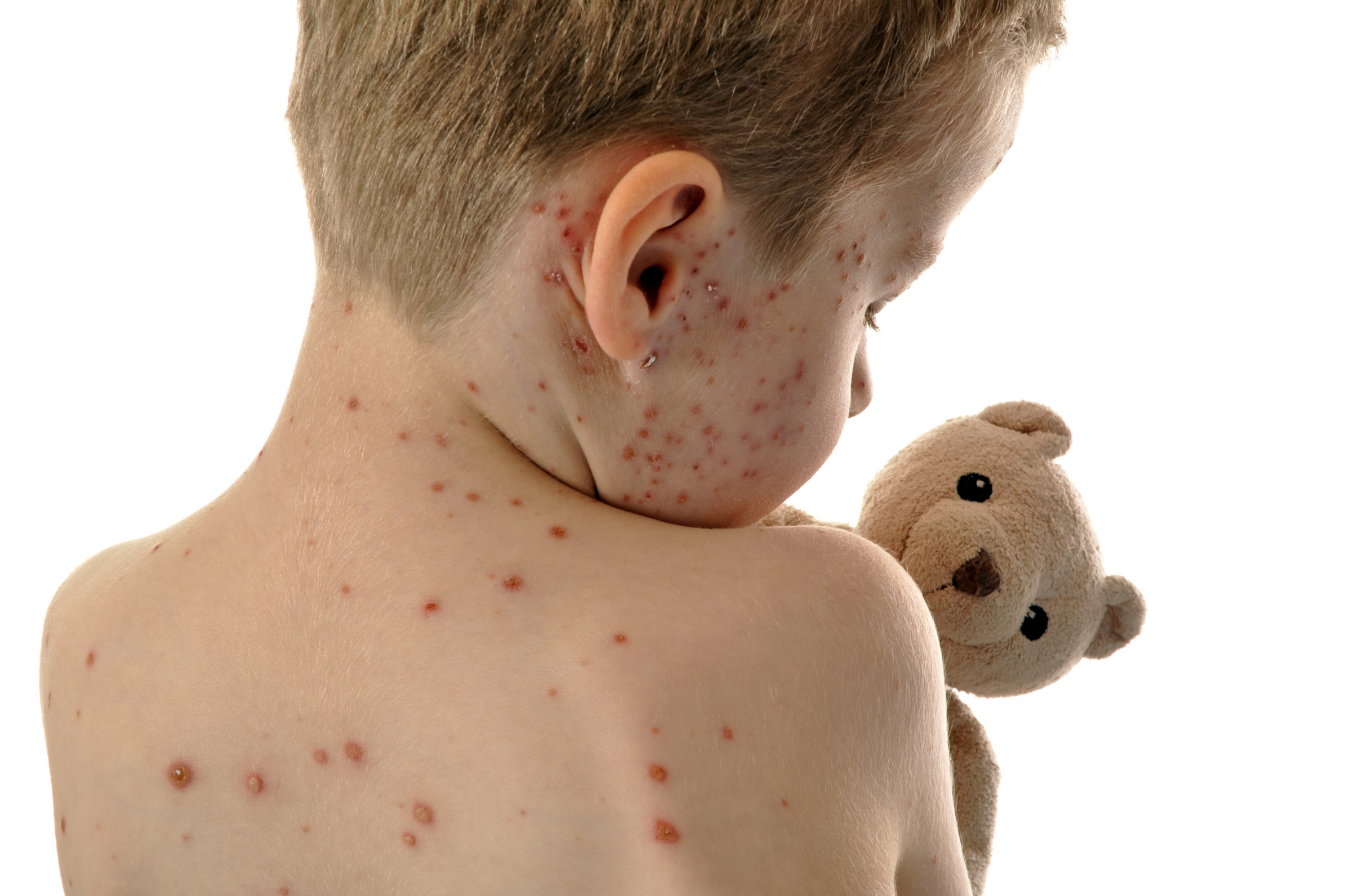 Photo: Measles can lead to serious complications like pneumonia and encephalitis