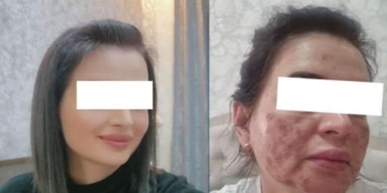 Toshkentdagi go‘zallik salonida ayolning yuzi 80 foiz kuydirib qo‘yildi 