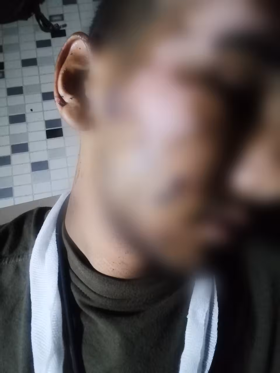 Jarohatdan so‘ng Jamshidning yuzida yirik shish va shrapnel izlari qoldi