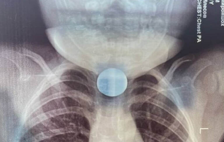 Buxoroda 2 yoshli bola tangalarni yutib yubordi (foto)