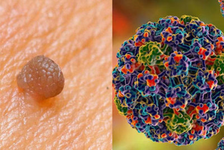 Papilloma nima va u qanday paydo bo‘ladi?